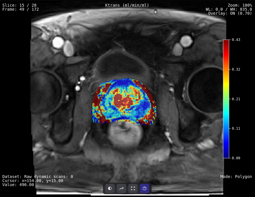 Prostate cancer perfusion maps