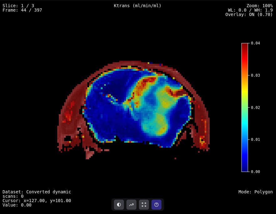 Glioblastoma perfusion maps